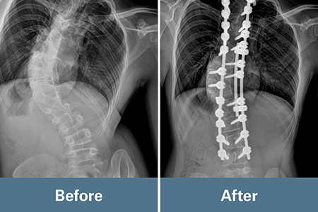 Before and after x-ray images of Kai's treatment