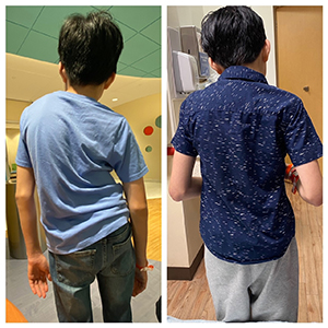 Before and after photos of Kai's back