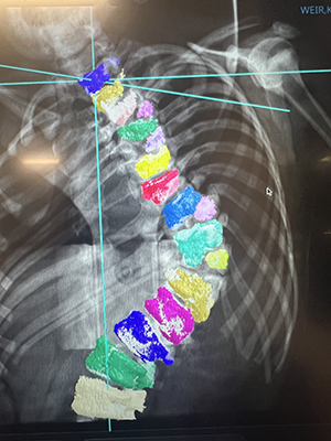 X-ray image of Kai's spine with congenital scoliosis