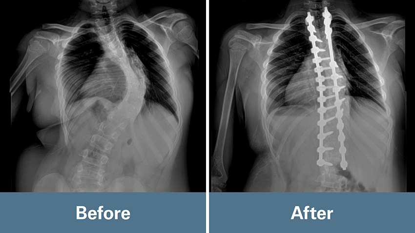 Before and after X-ray image of Louis Florentino's spine treatment