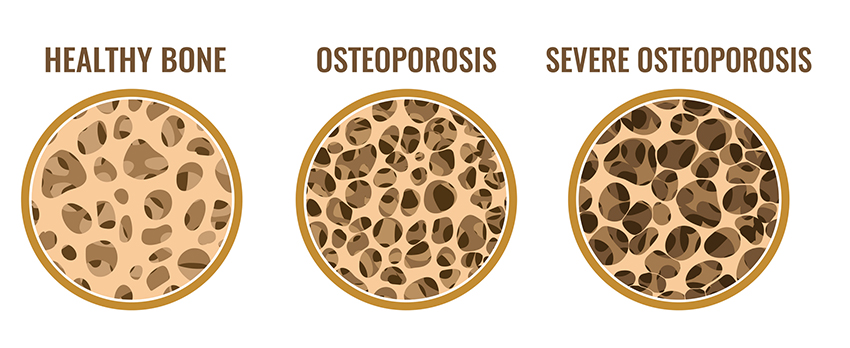 Diagram showing the progression of osteoporosis. Healthy bone, osteoporosis, and severe osteoporosis