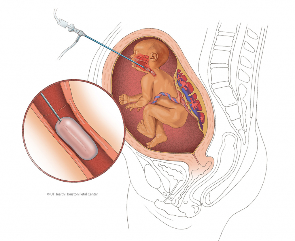 CDH Illustration