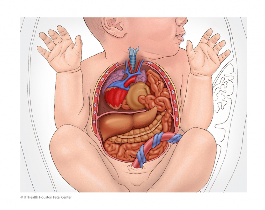 CDH Prenatal DX