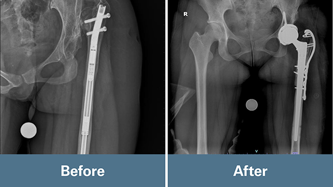 Before and after x-ray images of Anh's hip replacement surgery