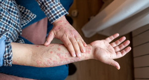 Eczema abrasions on a man's arm