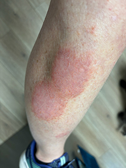 Nummular eczema on a woman's leg